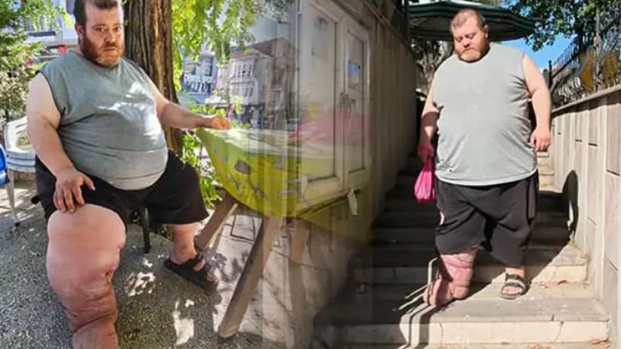 4 yıldır bu çileyi çekiyor! Kurtulmak için tek çaresi var!