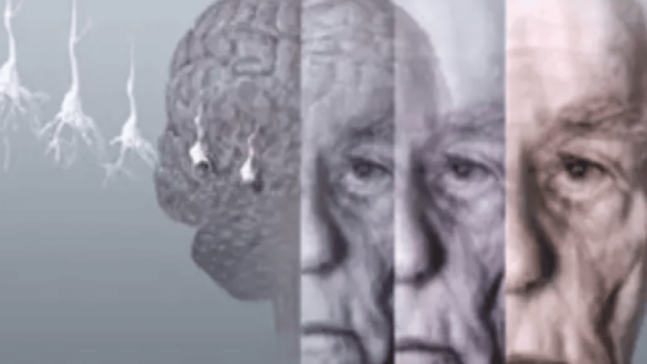 Foto - Beyin sağlığını korumada viral enfeksiyonlar... Alzheimer riskini 31 kat artırıyor! Dikkat Nörologlar açıkladı