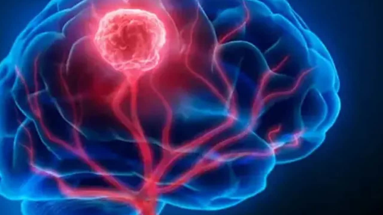 Foto - Bilim insanları ilk kez izledi! Tümör beyni böyle ele geçiriyor