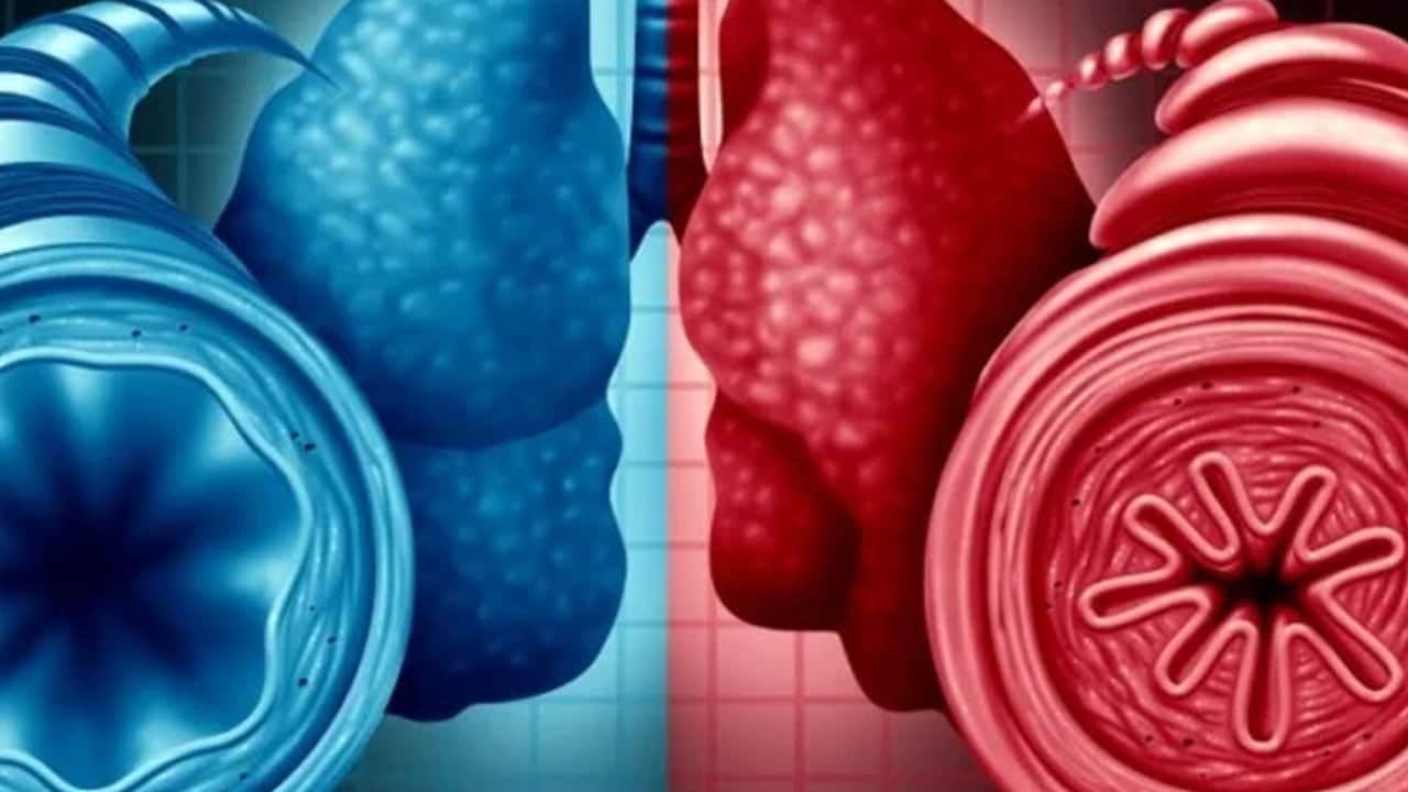 Foto - Bu 5 belirtiye dikkat: Nefes darlığı, göğüste sıkışmaya deyip geçmeyin: Akciğerleri nefessiz bırakıyor