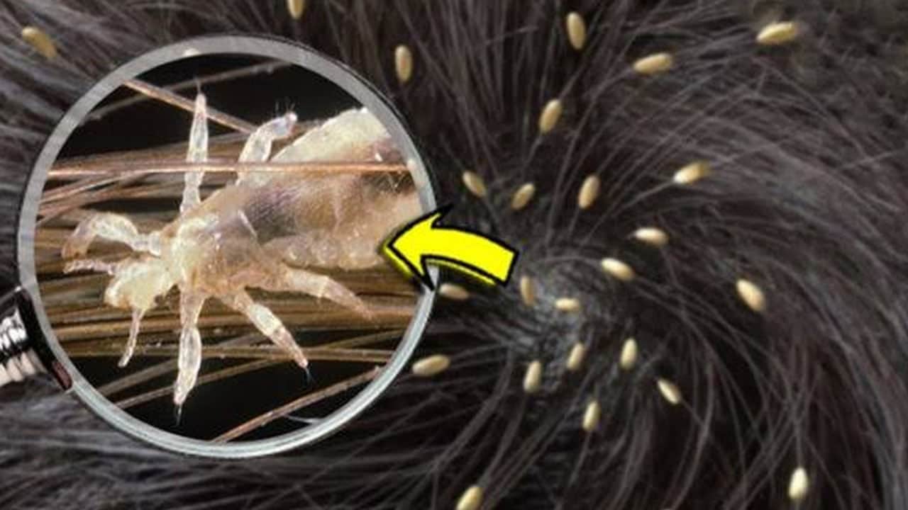 Foto - Bu hatayı sakın yapmayın... Uzmanından kritik uyarı: Bit temizliği çocuklarda korku yapıyor diyor... Büyük yanlışlık 