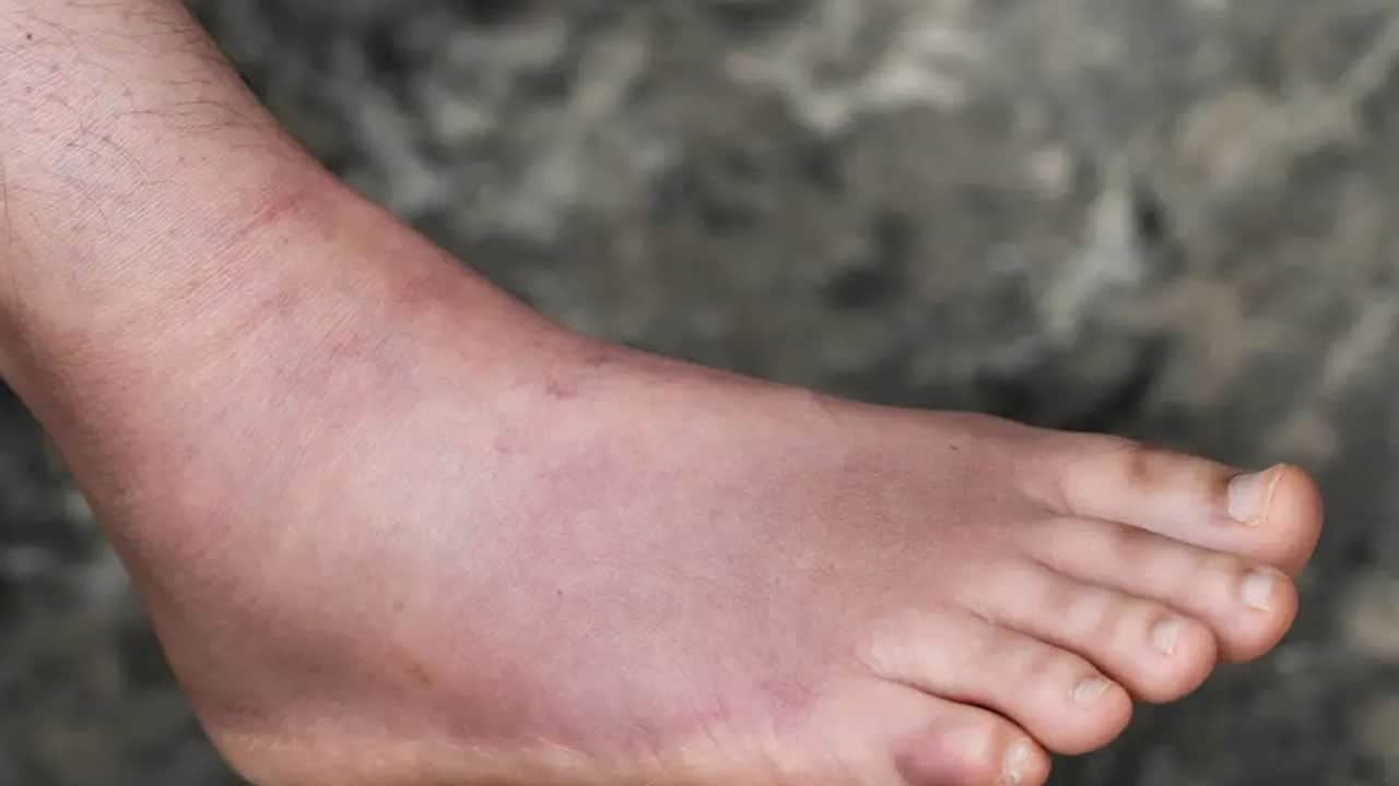 Foto - Çorap izi deyip geçmeyin! Çoğu kişi farkına bile varmıyor: Karaciğer ve böbrekler iflas ediyor olabilir