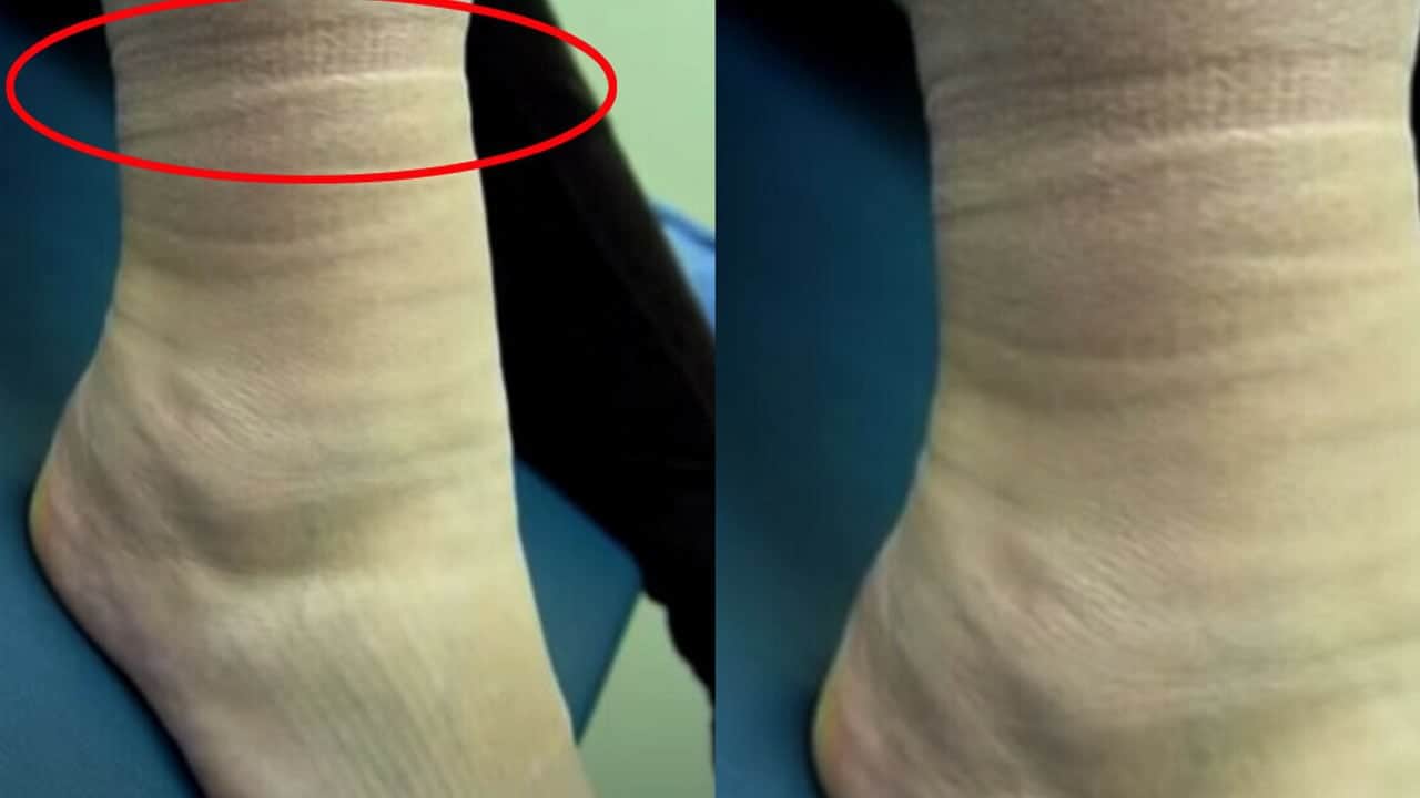 Foto - Çorap izi deyip geçmeyin: Göz ardı etmeyin, bakın ne anlama geliyor? Uzmanı bir tavsiye verdi 