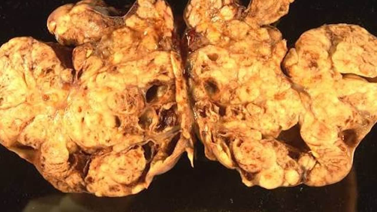 Foto - Fark edin, sinsi ilerliyor: Rahim kanseri riskiyle ilişkili! Bu belirtilere dikkat uyarısı geldi