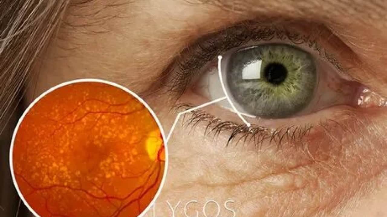 Foto - Göz kapaklarında beliren o sarı lekelere dikkat! Uzmanlar hayati tehlikeye karşı uyardı: Ölümün habercisi