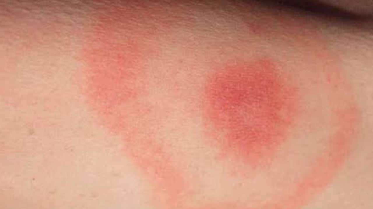 Foto - Halk sağlığı tehdidi büyüyor! Lyme hastalığı: Kene aşısı çalışmalarında ne yaptılar? 