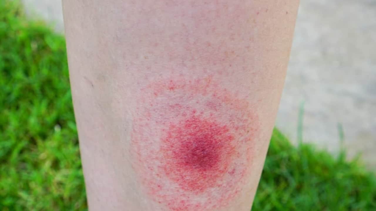 Foto - Halk sağlığı tehdidi büyüyor! Lyme hastalığı: Kene aşısı çalışmalarında ne yaptılar? 