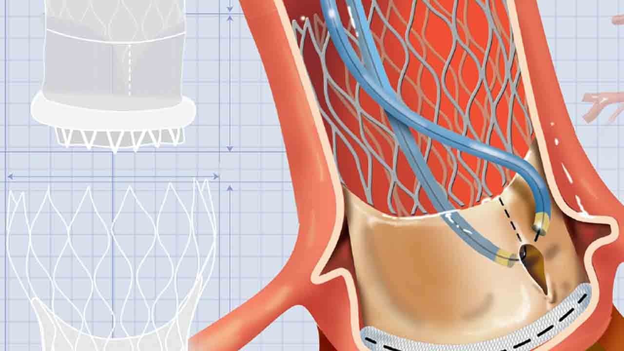 Foto - Kalp kapağında ezber bozan operasyon: Türk doktorlarından Türkiye’de bir ilk