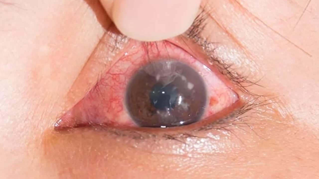 Foto - Kapalı açılı glokom nedir? Güvenlik önlemi için hangi tedbirleri alınmalı merak edildi...