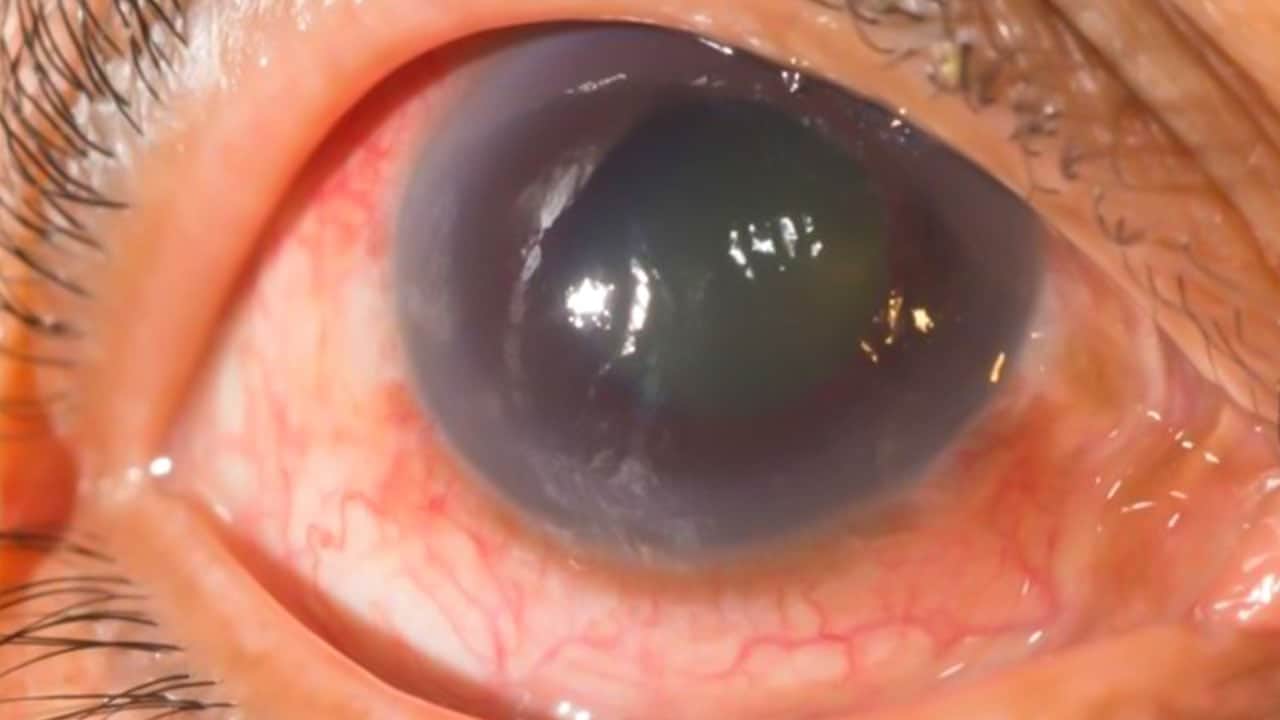 Foto - Kapalı açılı glokom nedir? Güvenlik önlemi için hangi tedbirleri alınmalı merak edildi...