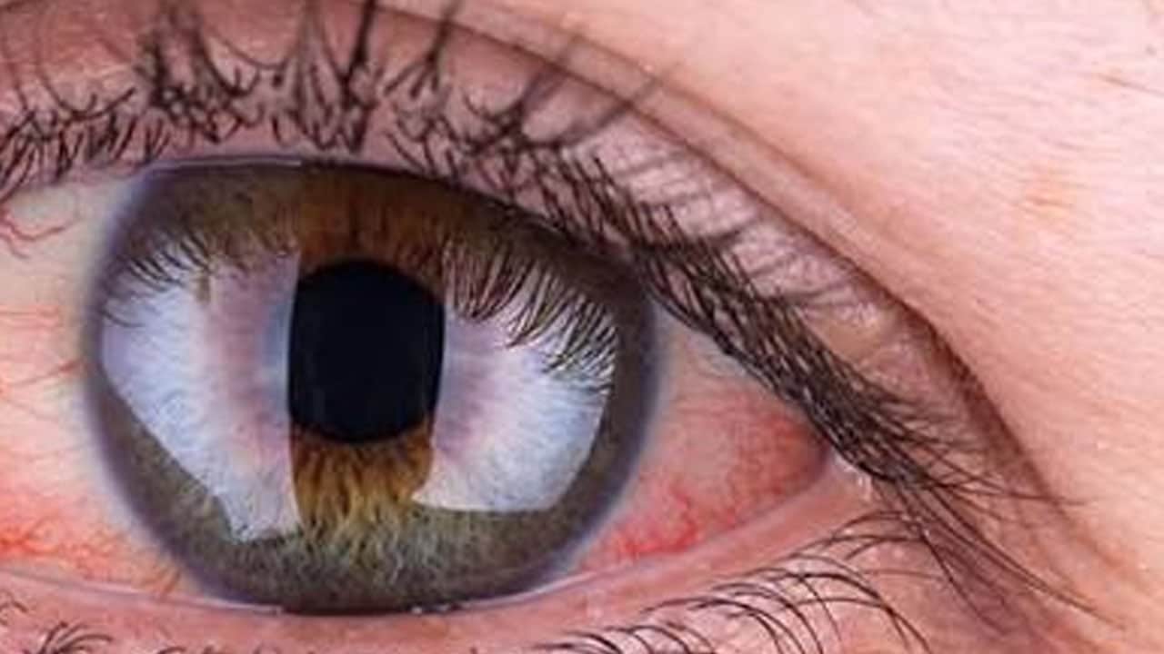 Kapalı açılı glokom nedir? Güvenlik önlemi için hangi tedbirleri alınmalı merak edildi...