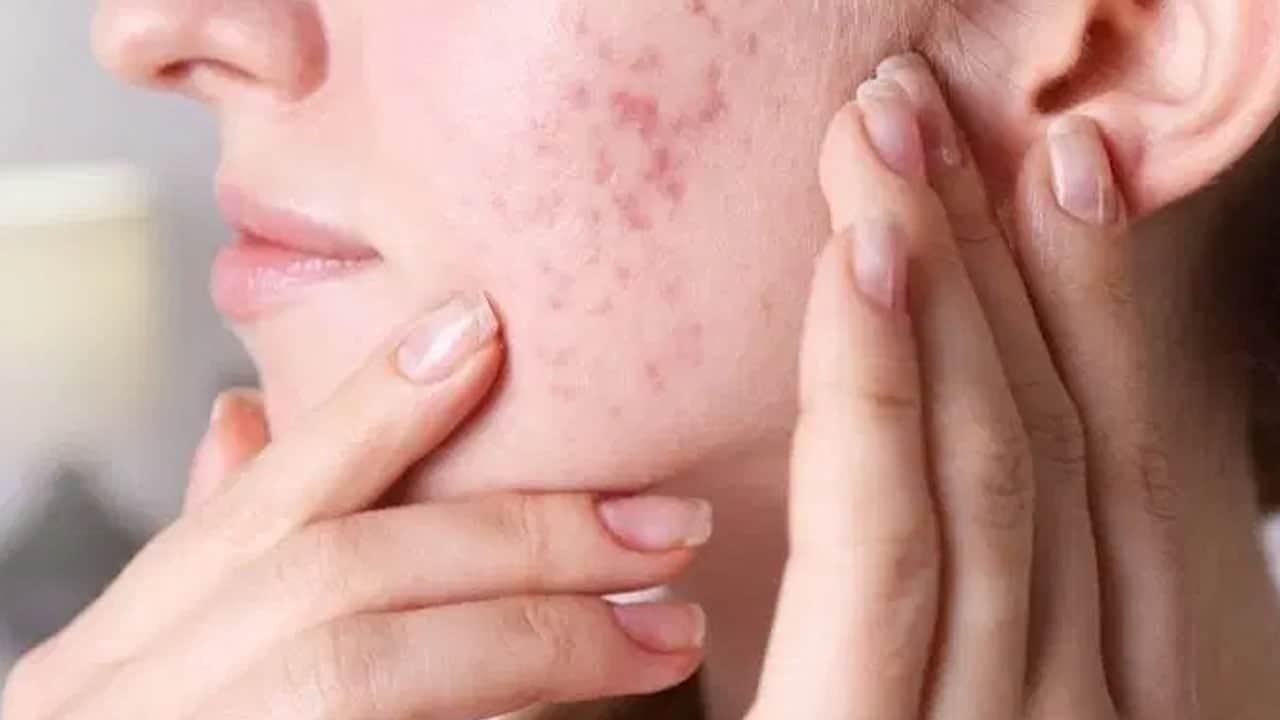 Foto - Kapalı açılı glokom nedir? Güvenlik önlemi için hangi tedbirleri alınmalı merak edildi...