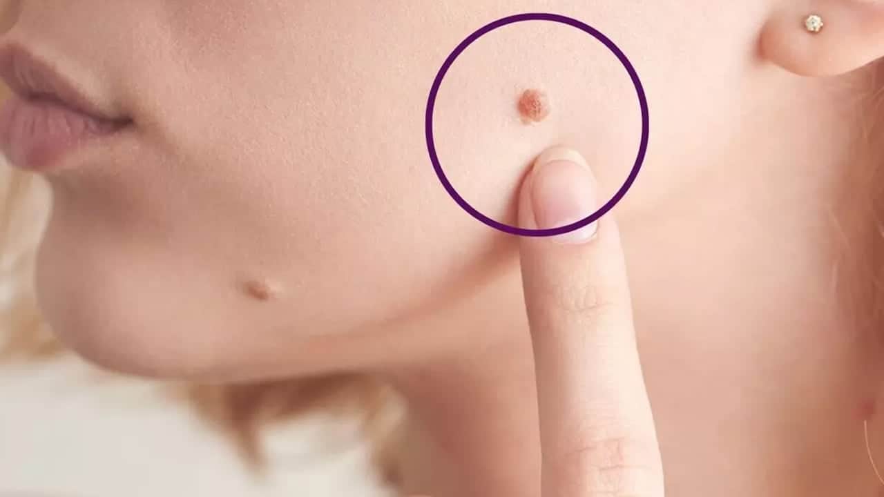 Foto - Kırmızı ben neden olur? Kırmızı et beni tehlikeli midir? İşte profesör tek tek anlattı, verilerini açıkladı 