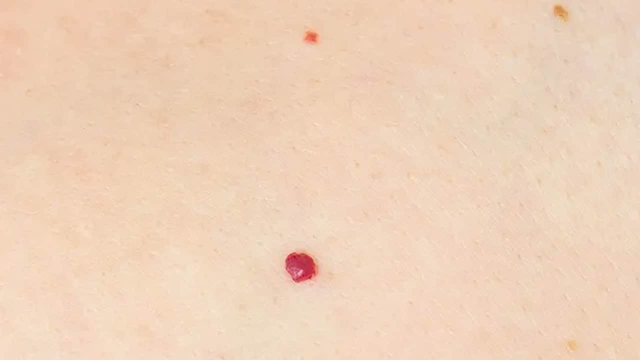 Foto - Kırmızı ben neden olur? Kırmızı et beni tehlikeli midir? İşte profesör tek tek anlattı, verilerini açıkladı 