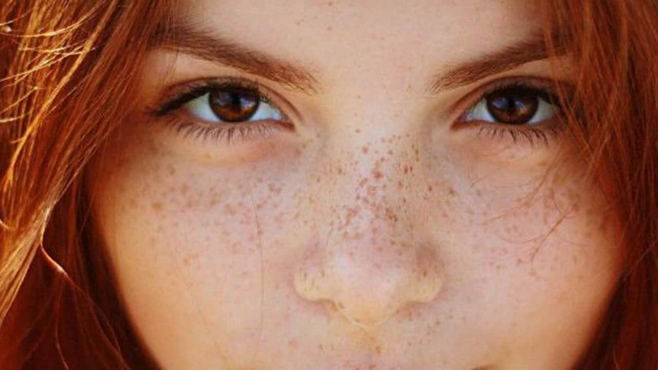 Foto - Leke silme formülü: Ciltten lekeler nasıl çıkarılır?