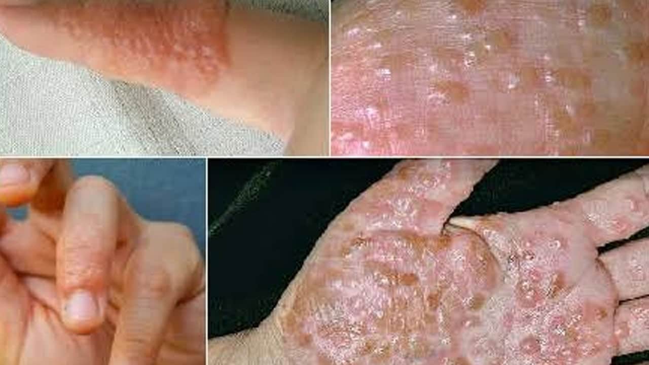 Foto - Mucize karışım: Ciltteki kaşıntıyı ve egzamayı bıçak gibi kesiyor! Pul pul dökülmeye karşı koruma yapıyor! Hangi karışım?
