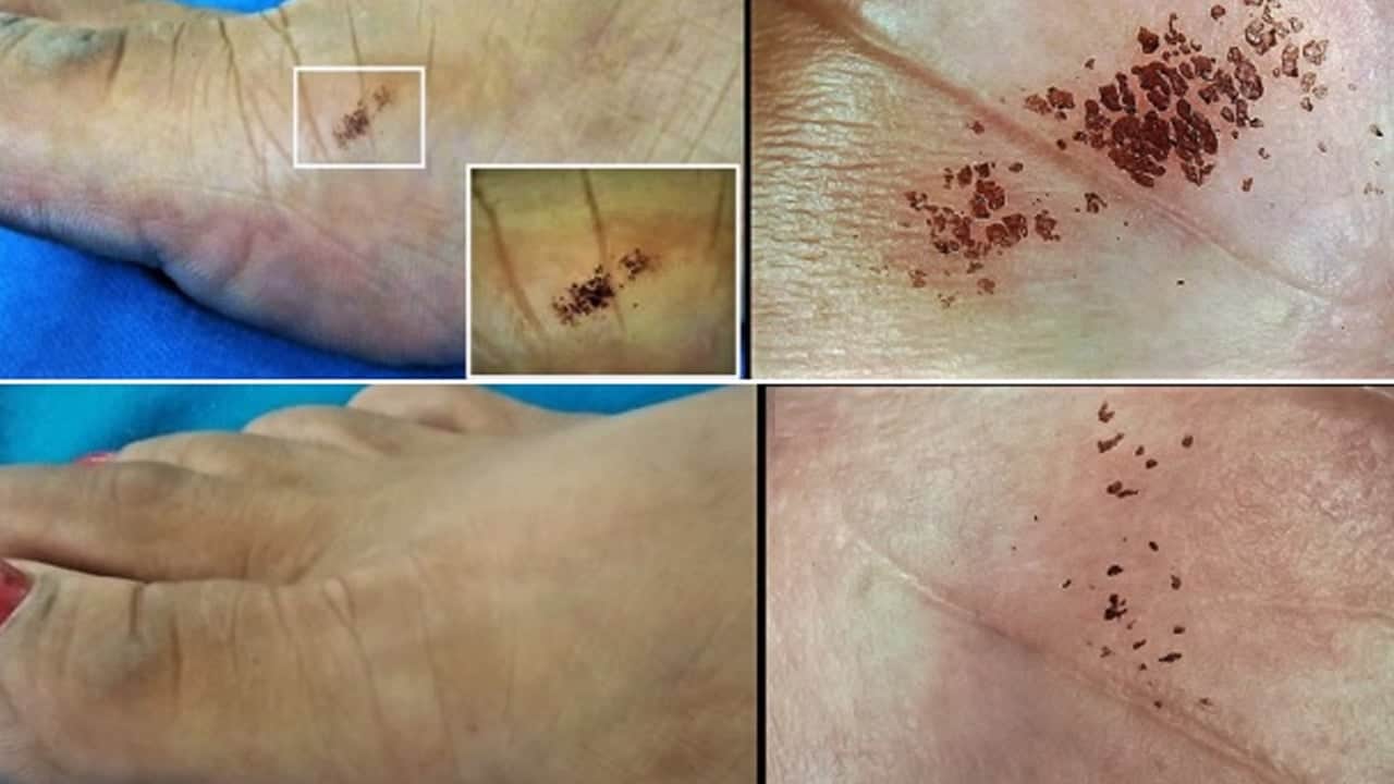 Pire ve böcek lekelerinden bir an önce kurtul: Vücudun her tarafı kabartı, soyulma var diyenler! Bunu yapın olacak