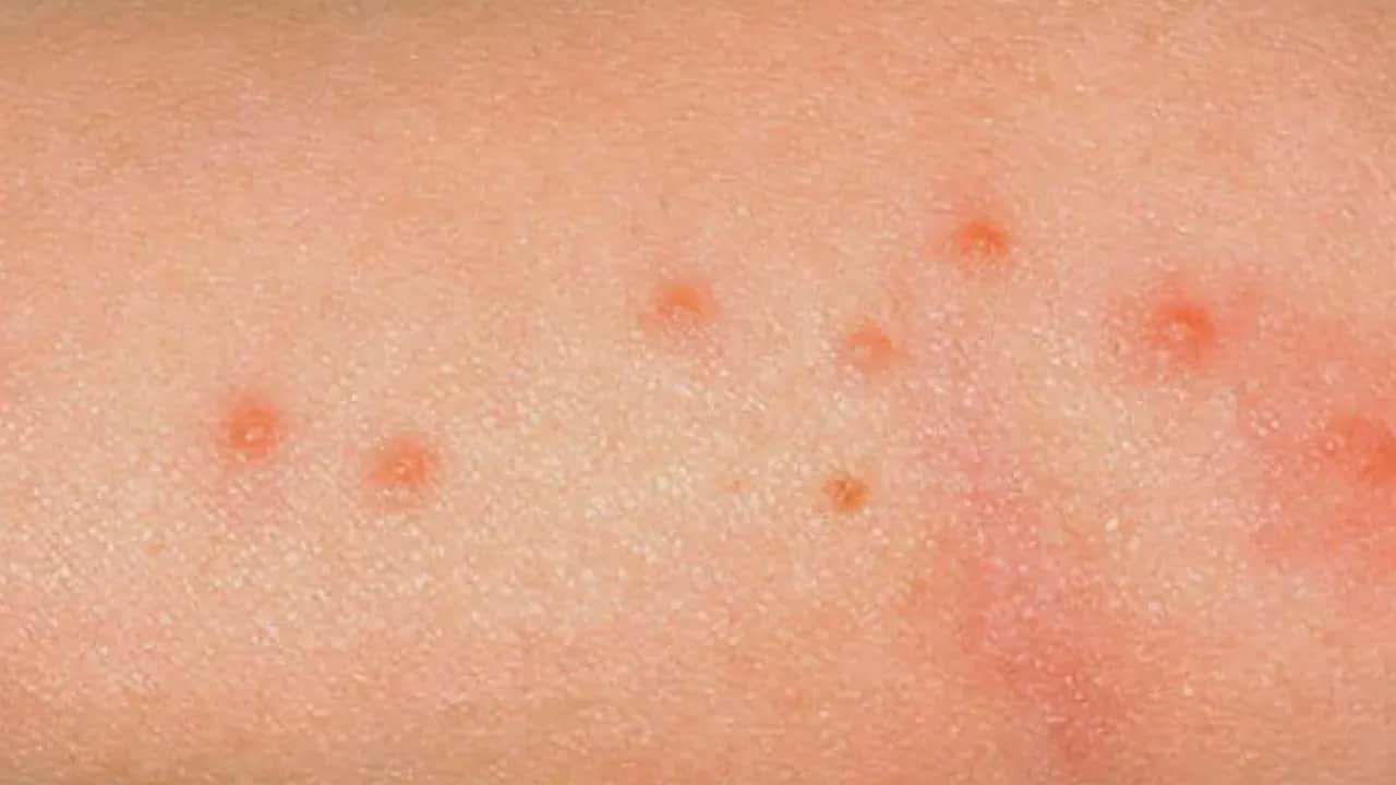 Foto - Pire ve böcek lekelerinden bir an önce kurtul: Vücudun her tarafı kabartı, soyulma var diyenler! Bunu yapın olacak