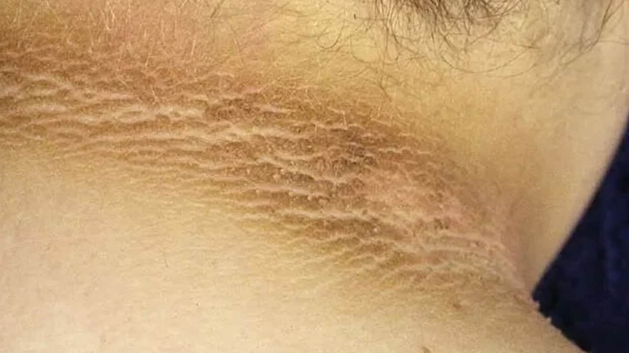 Foto - Şeker hastalığı sinsi ilerliyor: Bu belirtiler varsa sakın ihmal etmeyin! Erken teşhis büyük önem taşıyor