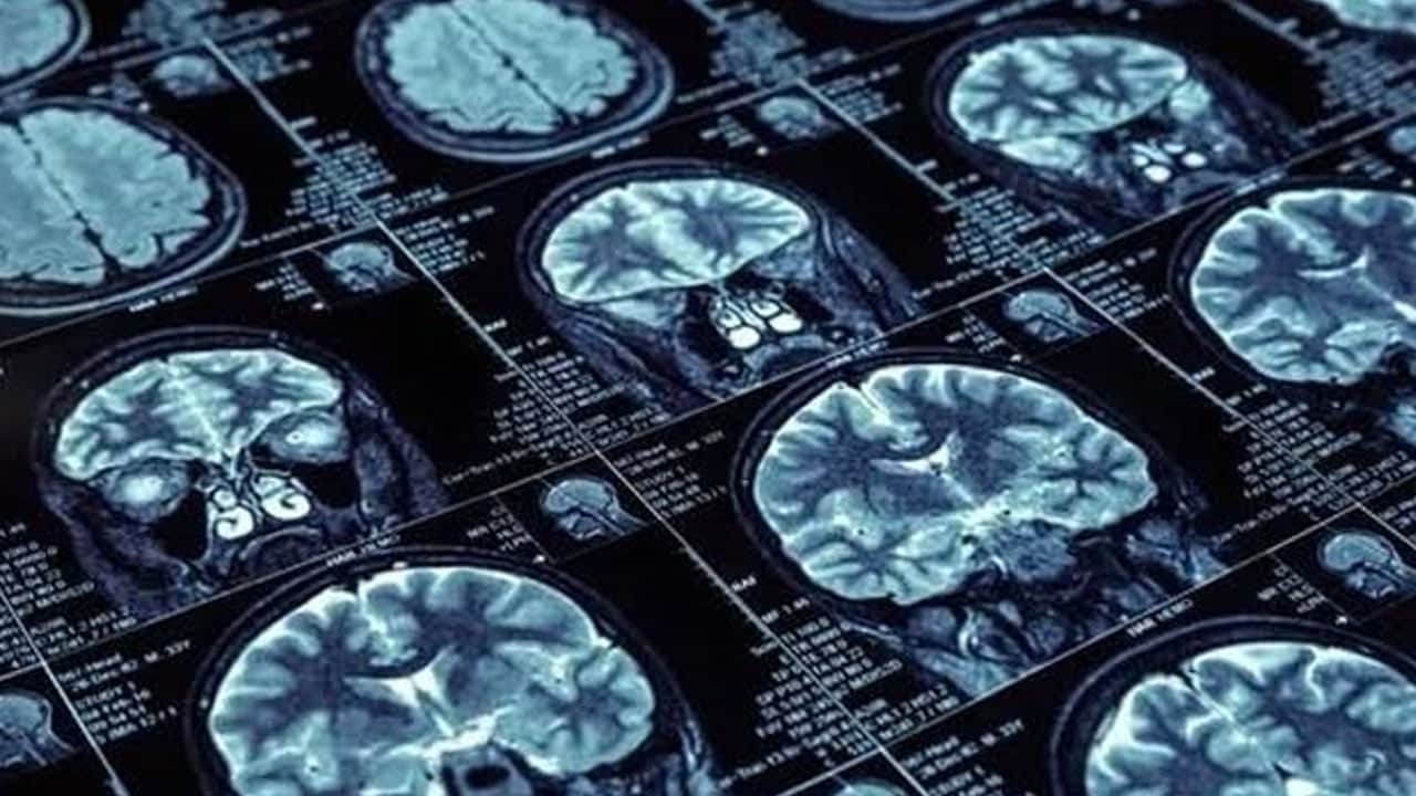 Foto - Uzmandan her unutkanlık alzheimer değildir uyarısı: Beyin için kritik bir açıklama ile ezberleri bozdu