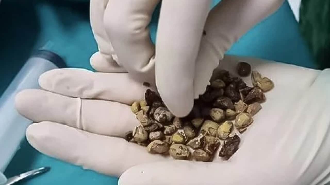 Foto - Uzmanı özellikle uyardı! ‘Yaz sıcakları böbrek taşını tetikliyor'