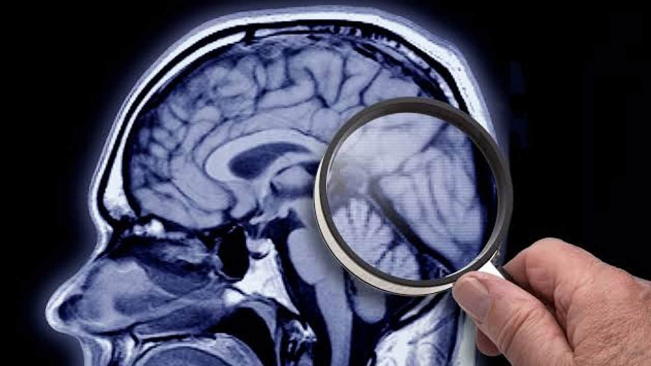 Foto - Yıllardır çaresiz deniyordu! Alzheimer bu yöntemle artık tedavi edilebilecek
