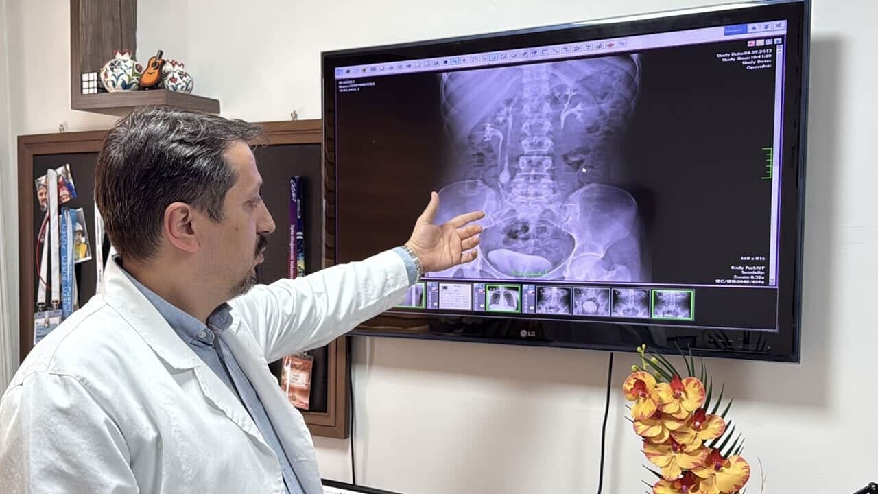 Doktorlar da şaştı! İdrar kanalından 51 adet taş çıktı