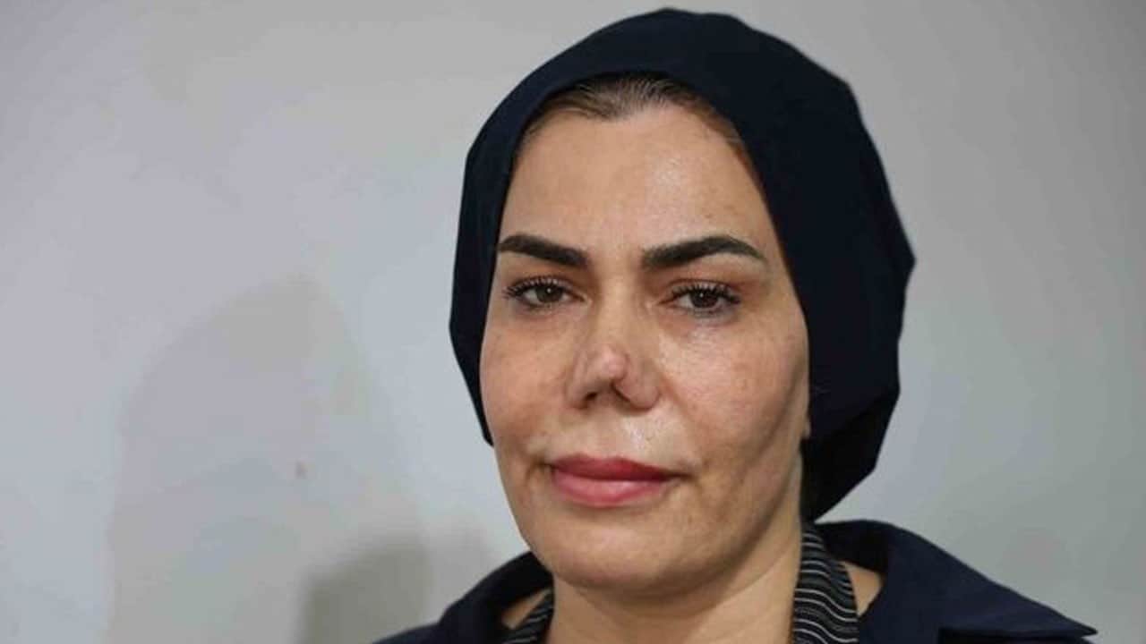 4 yılda 4 kez bıçak altına yattı! Burun estetiği faciası hayatını kabusa çevirdi
