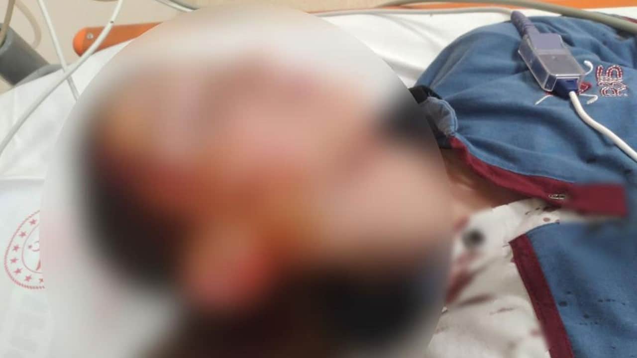 Bakkaldan dönerken yüzünü köpek parçalamıştı! Yaralı çocuğa 1 milyon 200 bin lira tazminat