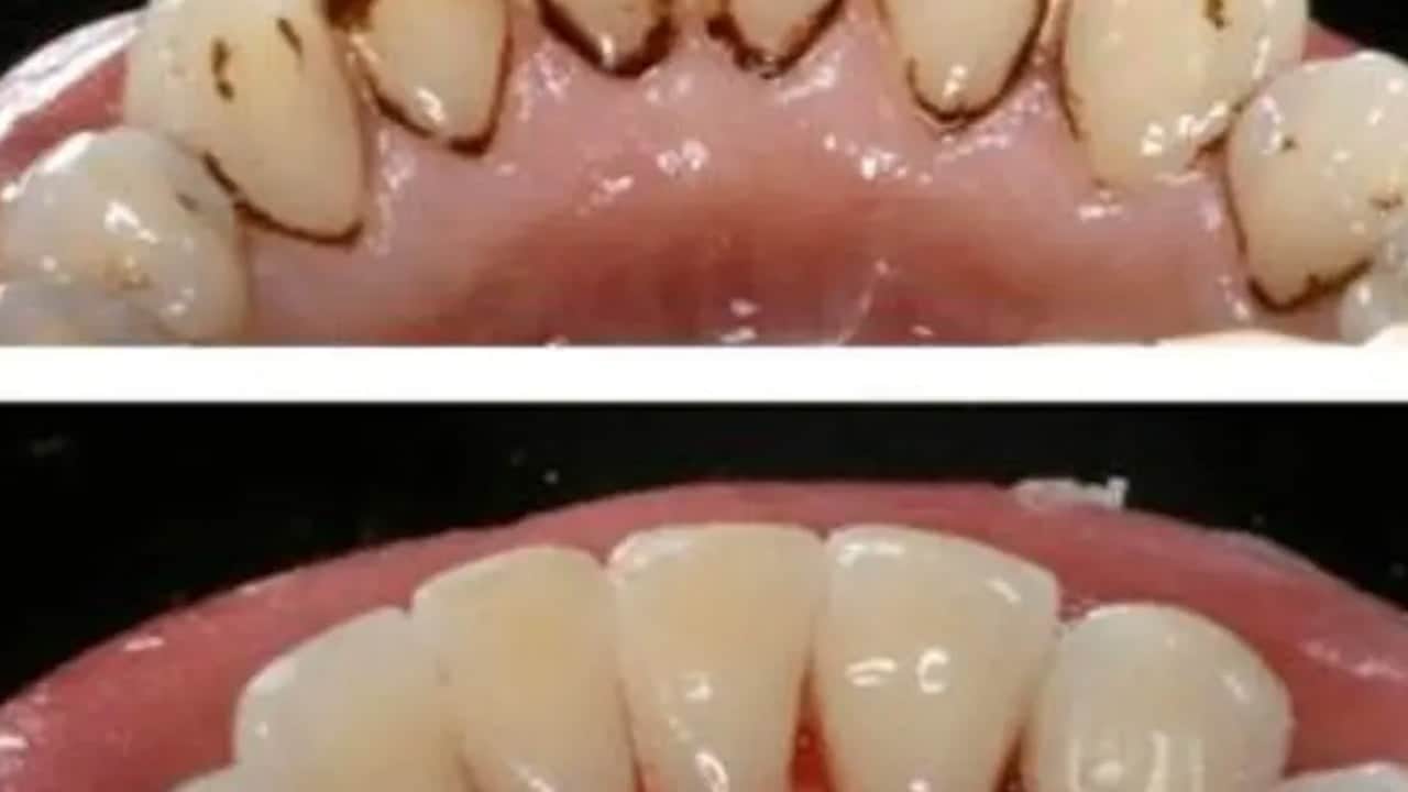 Diş tartarı nasıl temizlenir? Kanıtlanmış 10 yöntem... En iyi diş temizleme: 20 dakika! İsteyen bu yağı sürecek...