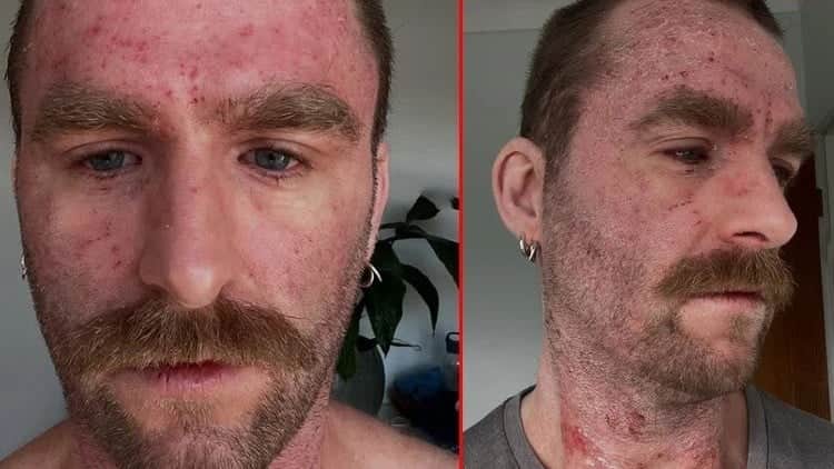 Egzama ile geçen 37 yıllık azap! Bu yaptığı ile ilacın yapamadığını yaptı kurtuldu