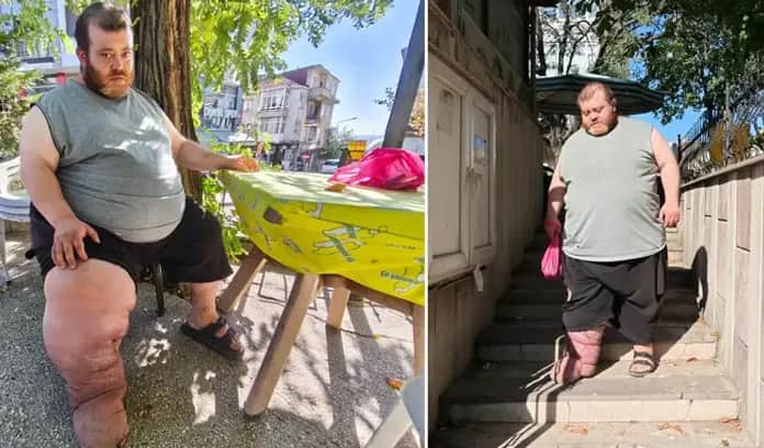 Fil hastalığı hayatını kararttı! Kazım’ın tek hedefi yeniden yürümek