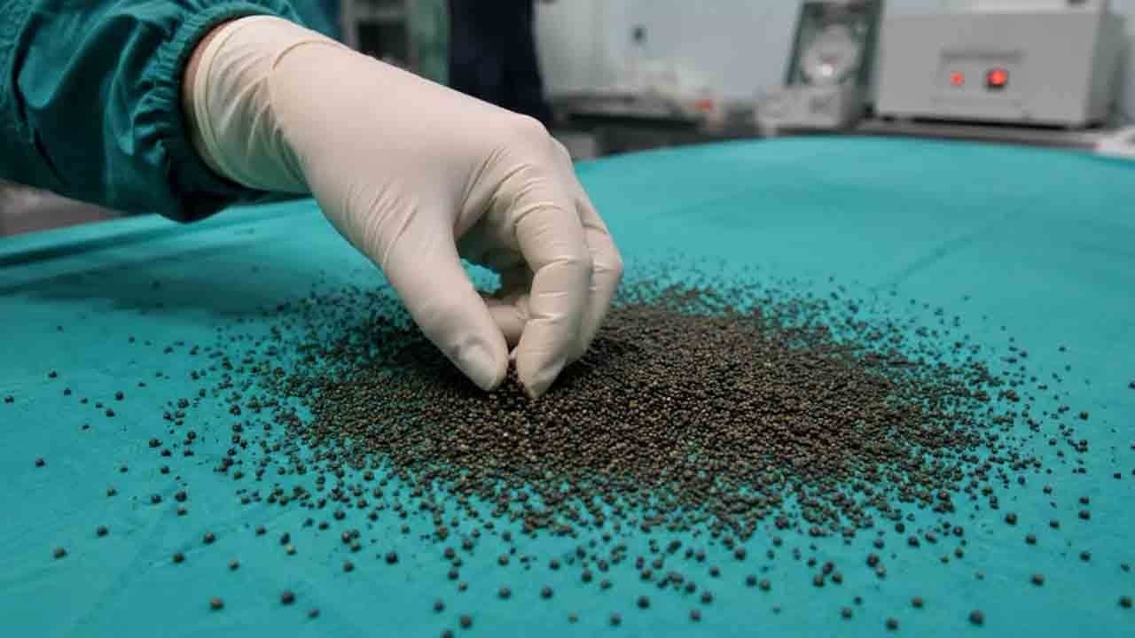 Geçmeyen ağrıların sırrı: Safra kesesinden çıkan 3 bin taş