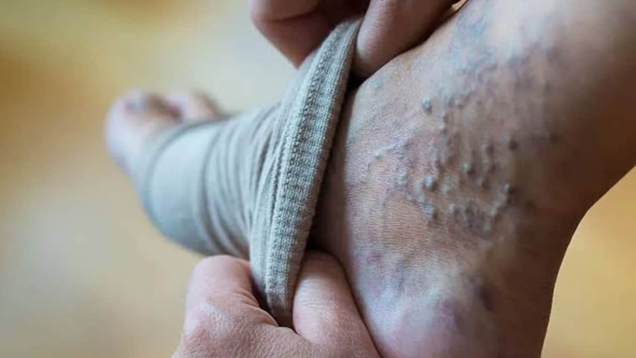 Güneş, sıcak duş, sauna...Varis şikâyetin varsa bunlardan uzak dur!