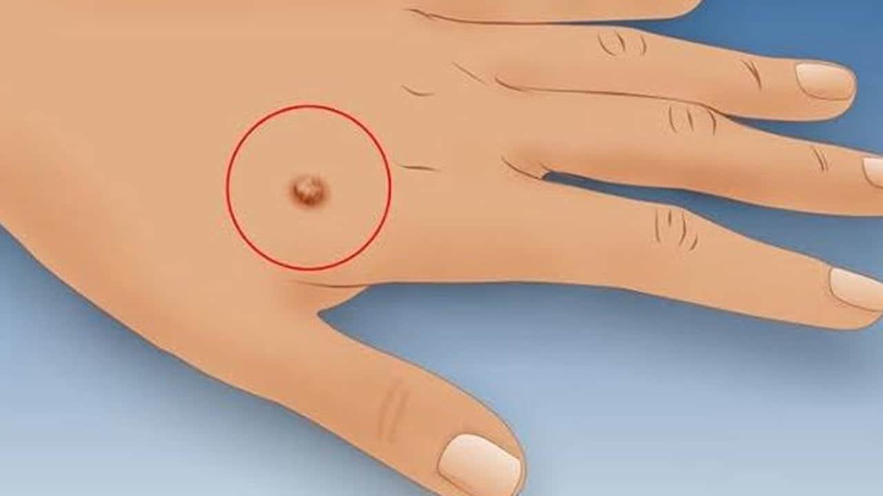 Siğillerden ağrısız kurtulmanın en kolay yolu neler oluyor hiç duydunuz mu? Püf noktaları buymuş