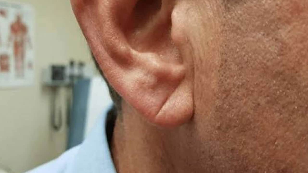 Son günlerde herkes bu detayı konuşuyor! Kulağında Frank çizgisi olanlar ne yapmalı?
