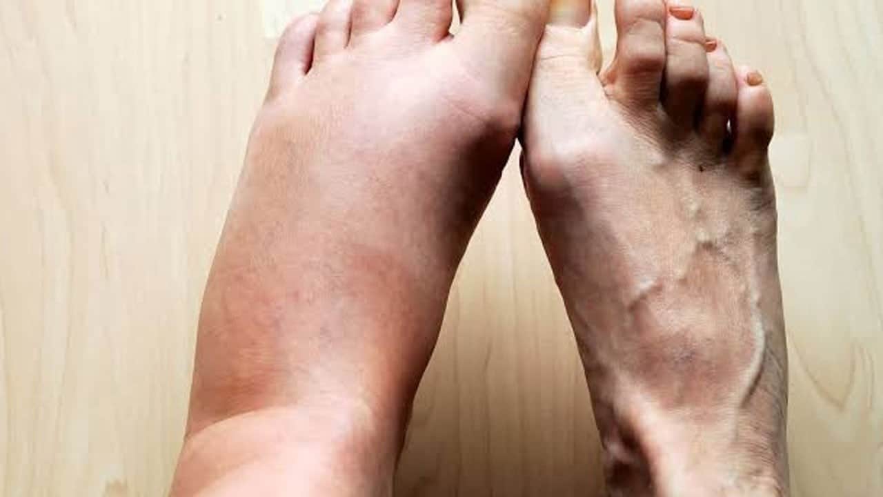 Tek bacakta ani şişlik ve ağrıya dikkat! Basit sanılan belirti hayati risk taşıyabilir
