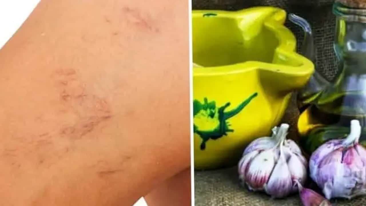 Varis neden olur, nasıl geçer? Sarımsak ile evde varis tedavisi: Erkeklerde de sorun sürüyor! ABD teyit etti...