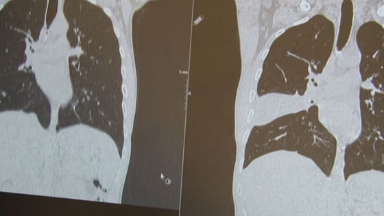 Doktorlar bile şaşırdı kaldı! Akciğerindeki şüpheli lezyonun sırrı ameliyatta çözüldü