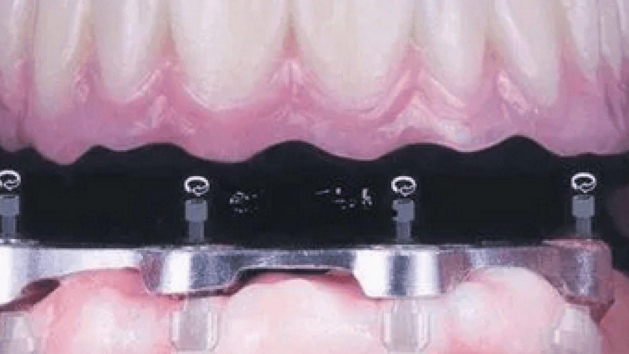Foto - 18 yaşından 85 yaşına kadar... Sigara implant kaybının en büyük nedenlerinden biri