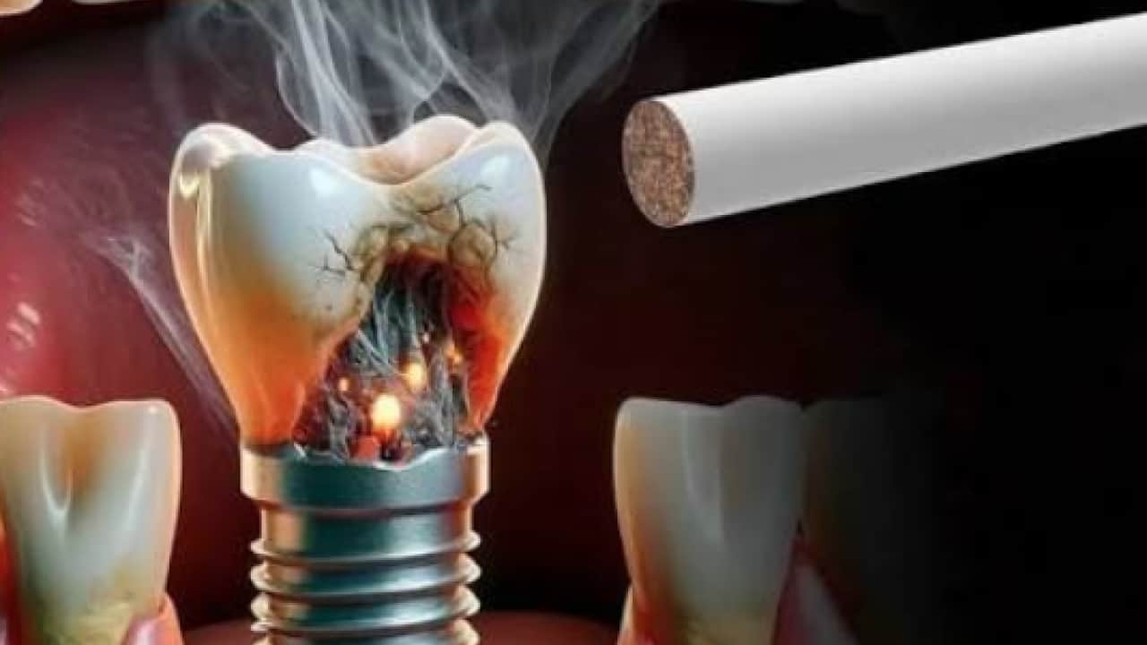 Foto - 18 yaşından 85 yaşına kadar... Sigara implant kaybının en büyük nedenlerinden biri
