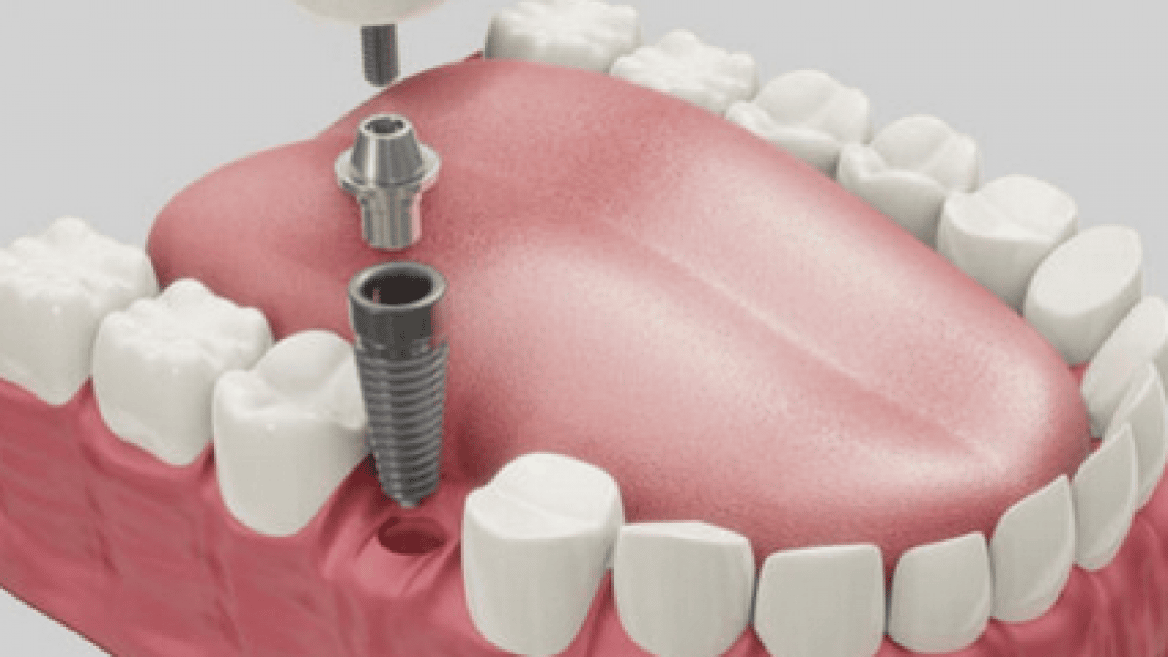 Foto - 18 yaşından 85 yaşına kadar... Sigara implant kaybının en büyük nedenlerinden biri