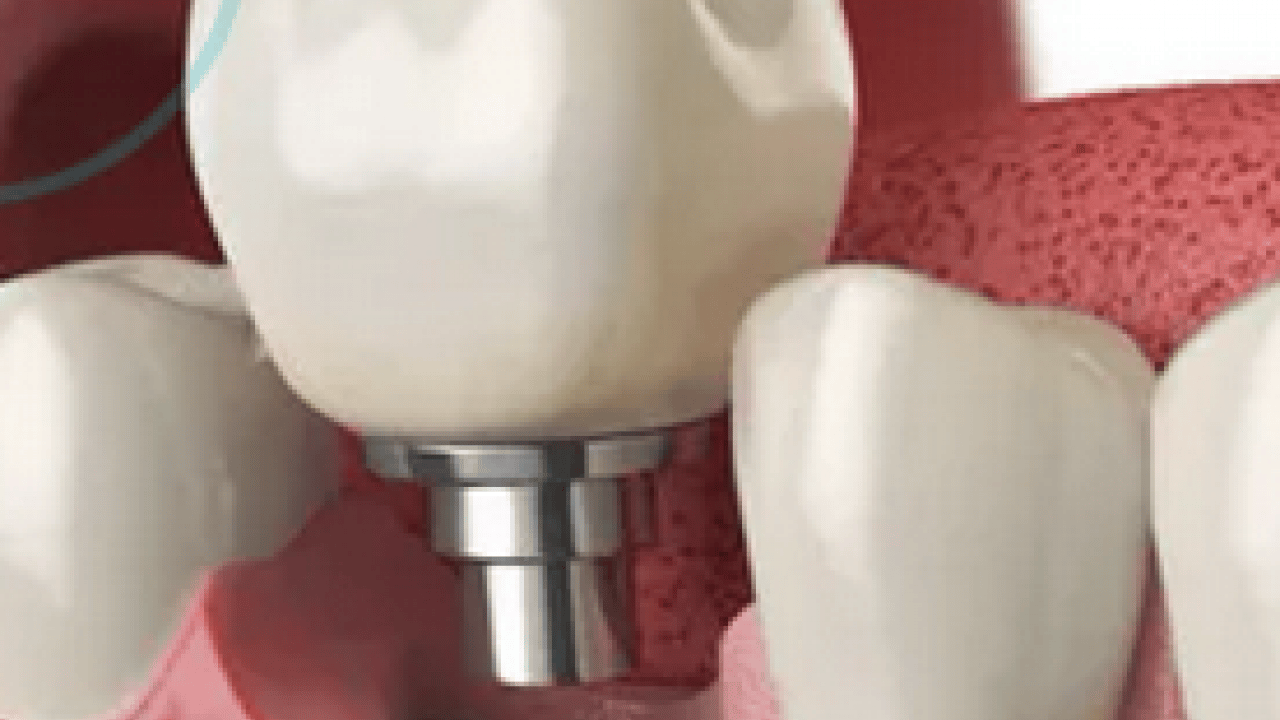 Foto - 18 yaşından 85 yaşına kadar... Sigara implant kaybının en büyük nedenlerinden biri