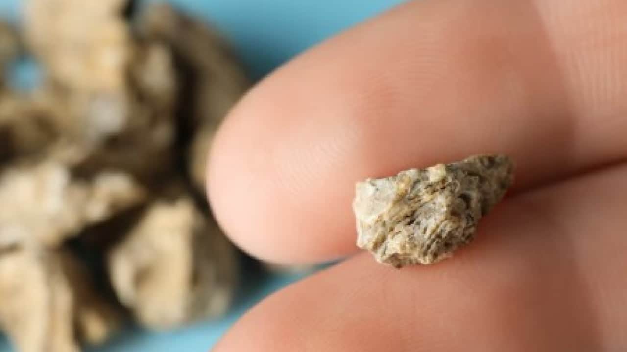 Foto - Böbrek taşı vakalarında dikkat çeken artış: Her 10 kişiden biri risk altında