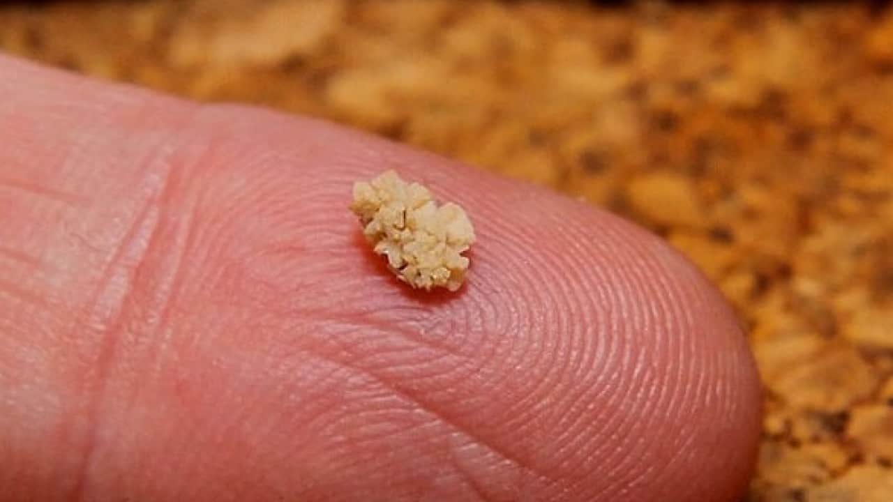 Foto - Böbrek taşı vakalarında dikkat çeken artış: Her 10 kişiden biri risk altında