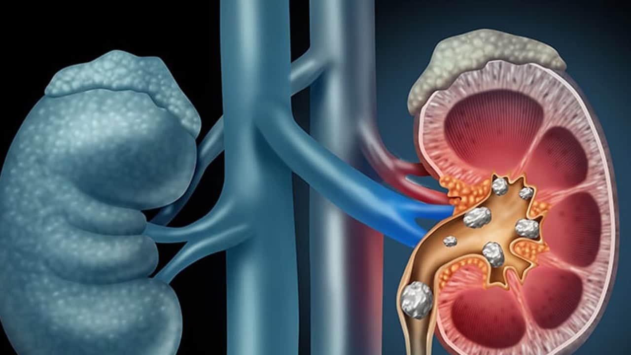 Foto - Böbrek taşını engellemeye yardımcı: Eriten 3 besin! Destek veriyor... Bir bakanın bir daha baktığı liste