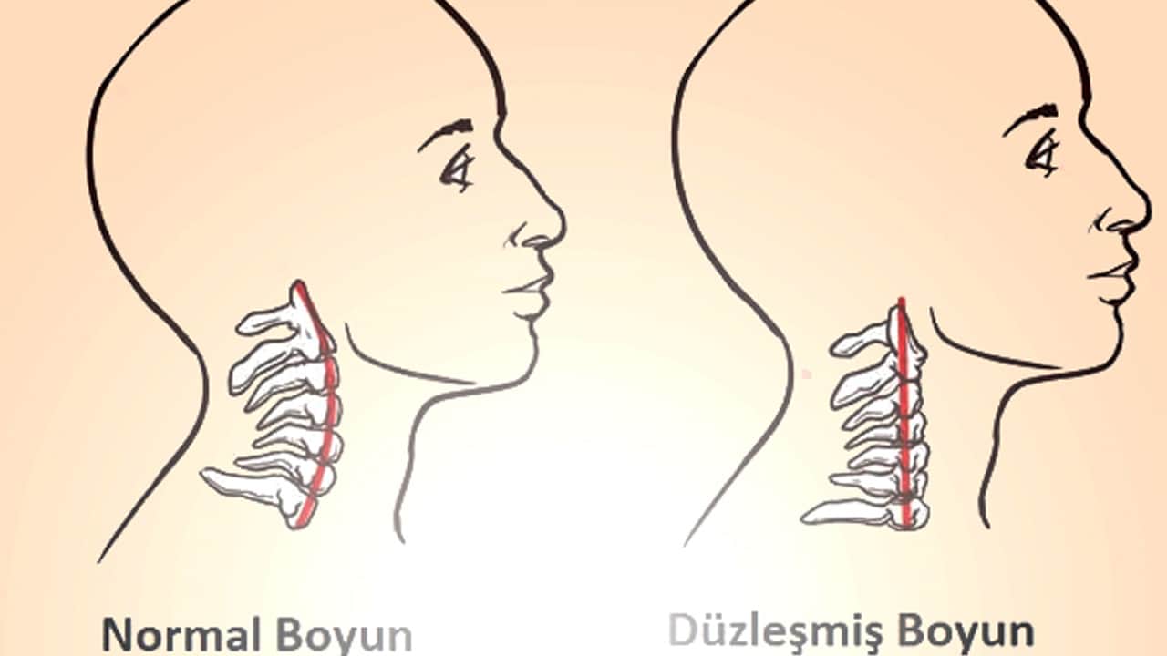 Foto - Boyun sağlığı ve boyun düzleşmesi için 7 tedavi seçeneği! En az 1'i yeter! İşte sırrı: Bakalım nasıl geçer?