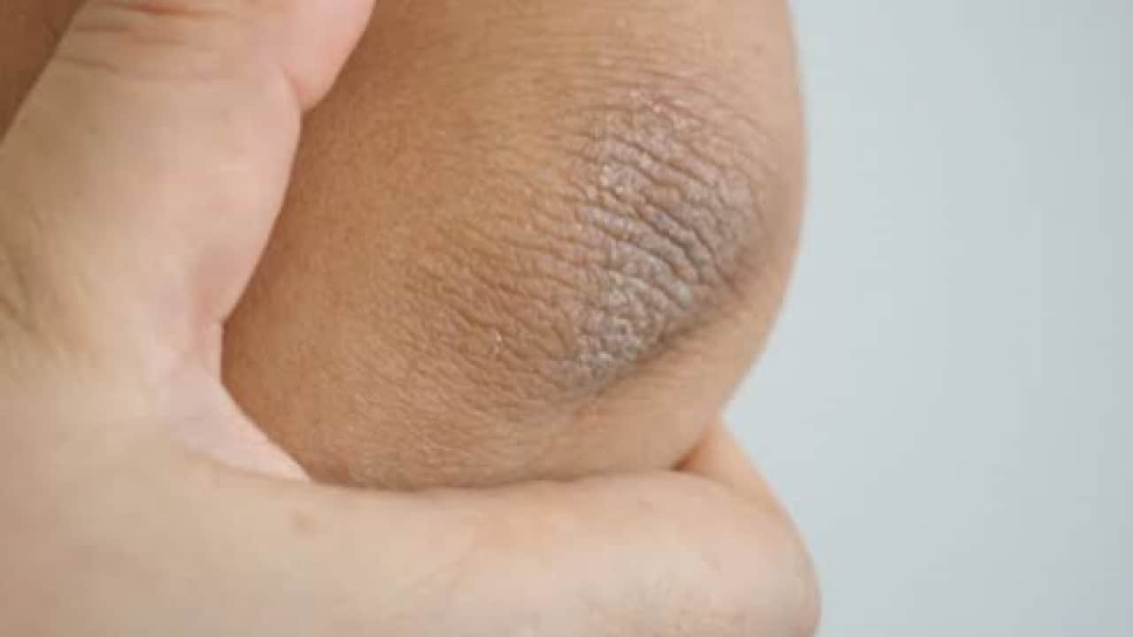 Foto - Bu ikiliyi karıştırıp sürün yeter: Dirsekteki kararmalara son son veriyor!