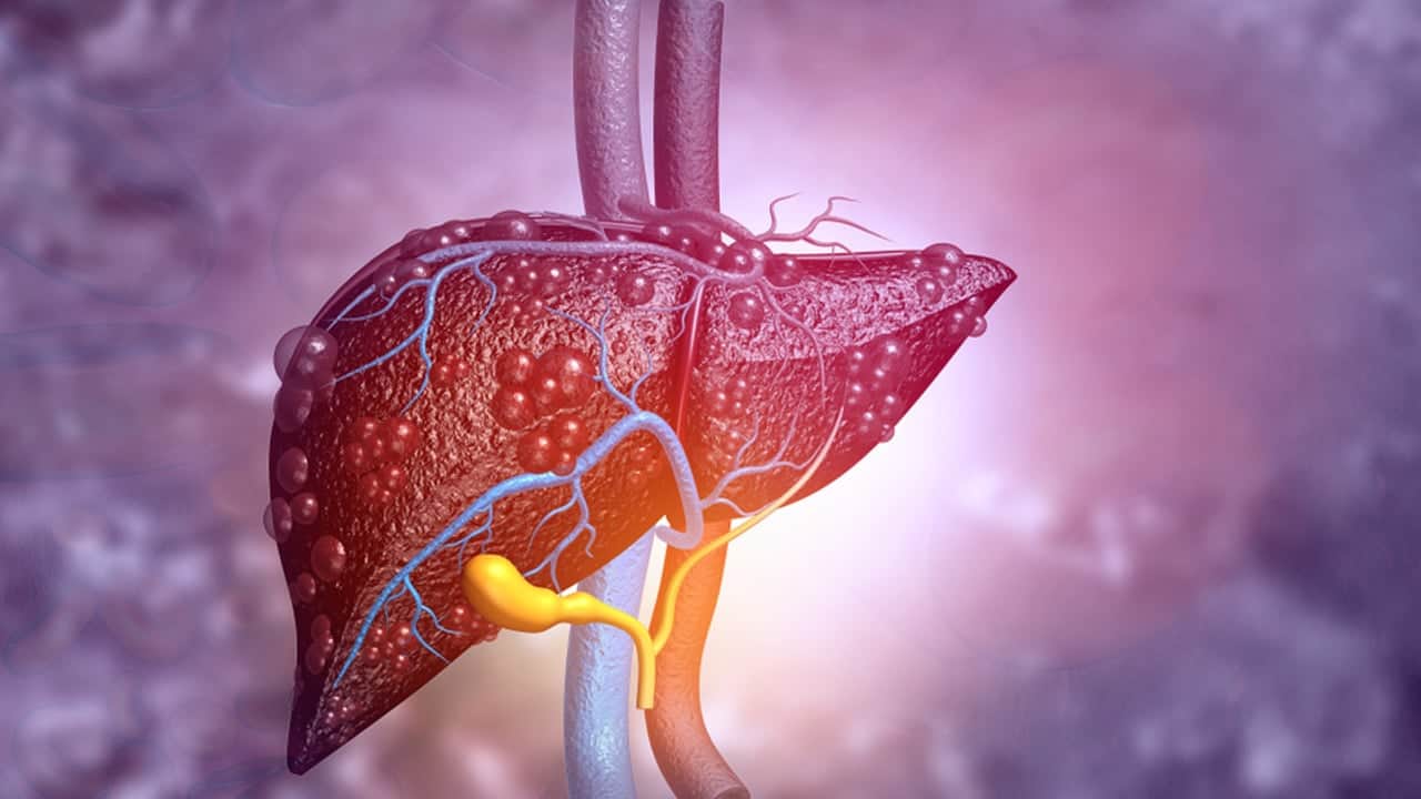 Foto - Karaciğeri yağlanması tehlikesi arttı uyarısı: Yalnız bunların hepsini yap kurtarıyor! Omega-3 ile son bulacak 