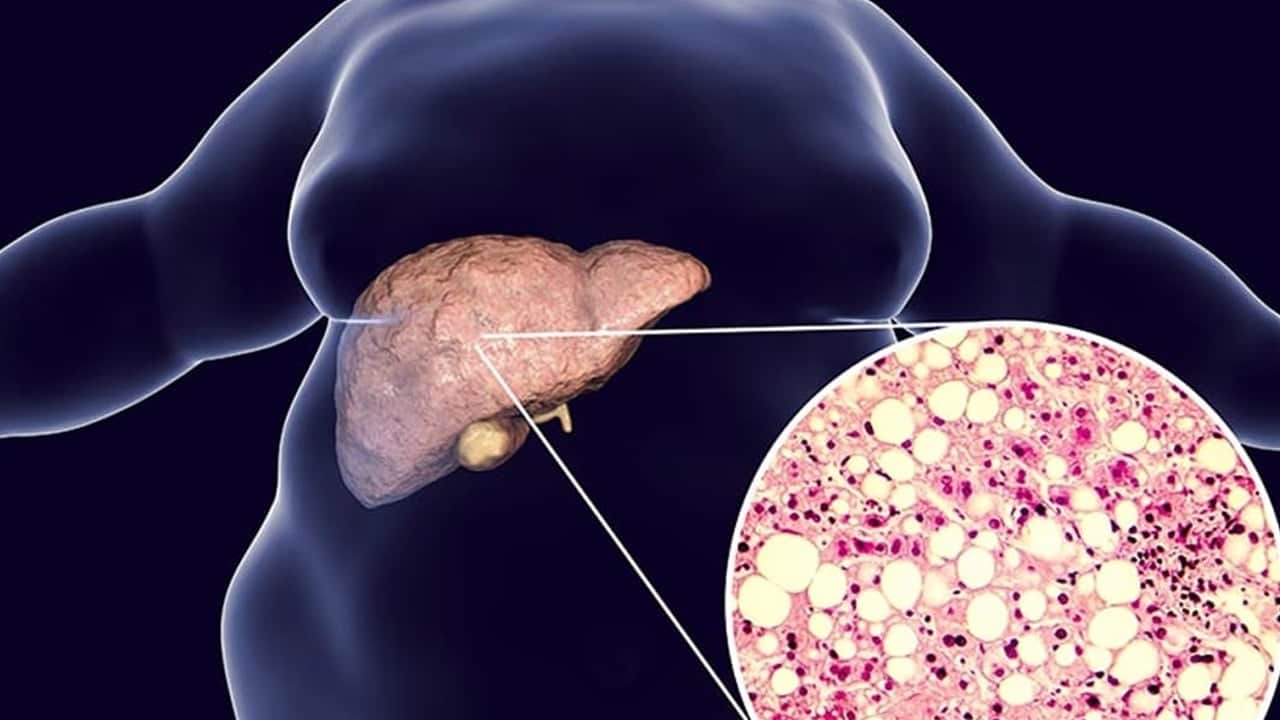 Foto - Karaciğeri yağlanması tehlikesi arttı uyarısı: Yalnız bunların hepsini yap kurtarıyor! Omega-3 ile son bulacak 
